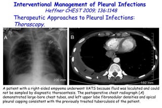 Interventional Management of Pleural Infections  Heffner CHEST 2009; 136:1148 Therapeutic Approaches to Pleural Infections:  Thorascopy . A patient with a right-sided empyema underwent VATS because fluid was loculated and could not be sampled by diagnostic thoracentesis. The postoperative chest radiograph ( A ) demonstrated large-bore chest tubes, and left upper lobe fibronodular densities and apical pleural capping consistent with the previously treated tuberculosis of the patient. 