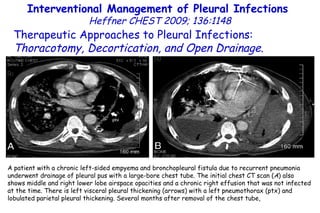 Interventional Management of Pleural Infections  Heffner CHEST 2009; 136:1148 Therapeutic Approaches to Pleural Infections:  Thoracotomy, Decortication, and Open Drainage . A patient with a chronic left-sided empyema and bronchopleural fistula due to recurrent pneumonia underwent drainage of pleural pus with a large-bore chest tube. The initial chest CT scan ( A ) also shows middle and right lower lobe airspace opacities and a chronic right effusion that was not infected at the time. There is left visceral pleural thickening (arrows) with a left pneumothorax (ptx) and lobulated parietal pleural thickening. Several months after removal of the chest tube, 