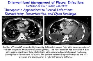 Interventional Management of Pleural Infections  Heffner CHEST 2009; 136:1148 Therapeutic Approaches to Pleural Infections:  Thoracotomy, Decortication, and Open Drainage . Another CT scan ( B ) showed a high-density, left-sided pleural fluid with no reexpansion of the left lung and a thick parietal pleura (arrow). The right effusion has increased in size with passive right lower lobe atelectasis, with associated parietal pleural thickening (arrow) due to intrapleural infection. The patient underwent open drainage of the left effusion and placement of a right intrapleural catheter. 