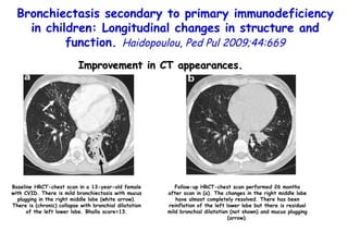 Bronchiectasis secondary to primary immunodeficiency in children: Longitudinal changes in structure and function.  Haidopoulou, Ped Pul 2009;44:669 Improvement in CT appearances. Baseline HRCT-chest scan in a 13-year-old female with CVID. There is mild bronchiectasis with mucus plugging in the right middle lobe (white arrow). There is (chronic) collapse with bronchial dilatation of the left lower lobe. Bhalla score=13. Follow-up HRCT-chest scan performed 26 months after scan in (a). The changes in the right middle lobe have almost completely resolved. There has been reinflation of the left lower lobe but there is residual mild bronchial dilatation (not shown) and mucus plugging (arrow). 