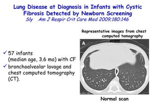 Lung Disease at Diagnosis in Infants with Cystic Fibrosis Detected by Newborn Screening Sly  Am J Respir Crit Care Med 2009;180:146  Normal scan Representative images from chest  computed tomography scans 57 infants  (median age, 3.6 mo) with CF bronchoalveolar lavage and chest computed tomography (CT).  