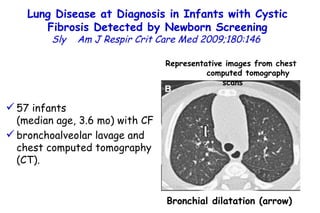 Lung Disease at Diagnosis in Infants with Cystic Fibrosis Detected by Newborn Screening Sly  Am J Respir Crit Care Med 2009;180:146  Bronchial dilatation (arrow) Representative images from chest  computed tomography scans 57 infants  (median age, 3.6 mo) with CF bronchoalveolar lavage and chest computed tomography (CT).  