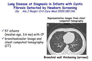 Lung Disease at Diagnosis in Infants with Cystic Fibrosis Detected by Newborn Screening Sly  Am J Respir Crit Care Med 2009;180:146  Bronchial wall thickening (arrows) Representative images from chest  computed tomography scans 57 infants  (median age, 3.6 mo) with CF bronchoalveolar lavage and chest computed tomography (CT).  