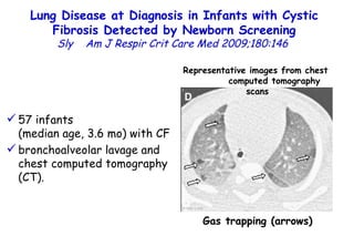 Lung Disease at Diagnosis in Infants with Cystic Fibrosis Detected by Newborn Screening Sly  Am J Respir Crit Care Med 2009;180:146  Gas trapping (arrows) Representative images from chest  computed tomography scans 57 infants  (median age, 3.6 mo) with CF bronchoalveolar lavage and chest computed tomography (CT).  