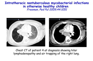 Intrathoracic nontuberculous mycobacterial infections in otherwise healthy children   Freeman, Ped Pul 2009;44:1051 Chest CT of patient 4 at diagnosis showing hilar lymphadenopathy and air trapping of the right lung. 