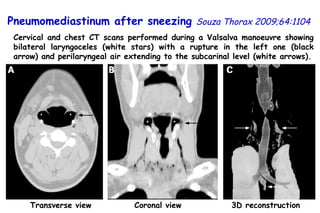 Transverse view Coronal view 3D reconstruction Cervical and chest CT scans performed during a Valsalva manoeuvre showing bilateral laryngoceles (white stars) with a rupture in the left one (black arrow) and perilaryngeal air extending to the subcarinal level (white arrows). Pneumomediastinum after sneezing   Souza Thorax 2009;64:1104 