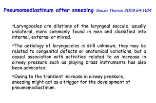 Laryngoceles are dilations of the laryngeal saccule, usually unilateral, more commonly found in men and classified into internal, external or mixed. The aetiology of laryngoceles is still unknown; they may be related to congenital defects or anatomical variations, but a causal association with activities related to an increase in airway pressure such as playing brass instruments has also been advocated. Owing to the transient increase in airway pressure, sneezing might act as a trigger for the development of pneumomediastinum. Pneumomediastinum after sneezing   Souza Thorax 2009;64:1104 