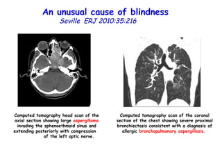An unusual cause of blindness   Seville   ERJ 2010:35:216  Computed tomography head scan of the axial section showing large  aspergilloma  invading the sphenoethmoid sinus and extending posteriorly with compression  of the left optic nerve.  Computed tomography scan of the coronal section of the chest showing severe proximal bronchiectasis consistent with a diagnosis of allergic  bronchopulmonary aspergillosis .  