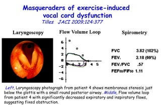Masqueraders of exercise-induced  vocal cord dysfunction Tilles   JACI 2009;124:377    Left ,  Laryngoscopy photograph from patient 4 shows membranous stenosis just below the glottis with a small round posterior airway.  Middle ,  Flow volume loop from patient 4 with significantly decreased expiratory and inspiratory flows, suggesting fixed obstruction.  