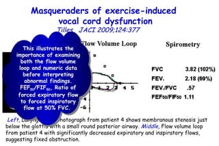 Masqueraders of exercise-induced  vocal cord dysfunction Tilles   JACI 2009;124:377    Left ,  Laryngoscopy photograph from patient 4 shows membranous stenosis just below the glottis with a small round posterior airway.  Middle ,  Flow volume loop from patient 4 with significantly decreased expiratory and inspiratory flows, suggesting fixed obstruction.  This illustrates the importance of examining both the flow volume loop and numeric data before interpreting abnormal findings. FEF 50 /FIF 50 , Ratio of forced expiratory flow to forced inspiratory flow at 50% FVC.  