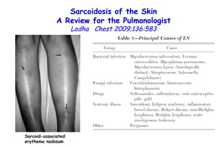 Sarcoidosis of the Skin A Review for the Pulmonologist Lodha  Chest 2009;136:583 Sarcoid-associated erythema nodosum 