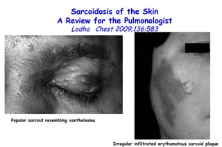 Sarcoidosis of the Skin A Review for the Pulmonologist Lodha  Chest 2009;136:583 Papular sarcoid resembling xanthelasma Irregular infiltrated erythamatous sarcoid plaque 