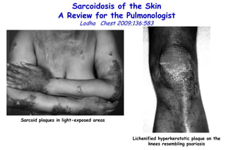 Sarcoidosis of the Skin A Review for the Pulmonologist Lodha  Chest 2009;136:583 Sarcoid plaques in light-exposed areas Lichenified hyperkeratotic plaque on the knees resembling psoriasis 