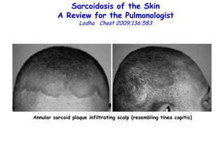 Sarcoidosis of the Skin A Review for the Pulmonologist Lodha  Chest 2009;136:583 Annular sarcoid plaque infiltrating scalp (resembling tinea capitis) 