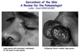 Sarcoidosis of the Skin A Review for the Pulmonologist Lodha  Chest 2009;136:583 Lupus pernio with prominent involvement of the nasal rin and eyelids Difiguring fibrotic nodular lupus pernio 
