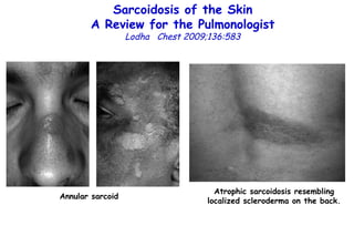 Sarcoidosis of the Skin A Review for the Pulmonologist Lodha  Chest 2009;136:583 Annular sarcoid Atrophic sarcoidosis resembling localized scleroderma on the back. 