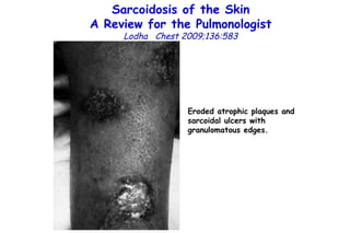 Sarcoidosis of the Skin A Review for the Pulmonologist Lodha  Chest 2009;136:583 Eroded atrophic plaques and sarcoidal ulcers with  granulomatous edges. 