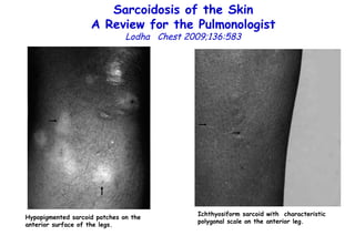 Sarcoidosis of the Skin A Review for the Pulmonologist Lodha  Chest 2009;136:583 Hypopigmented sarcoid patches on the anterior  surface of the legs. Ichthyosiform sarcoid with  characteristic polygonal scale on the anterior leg. 