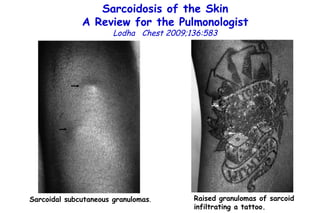 Sarcoidosis of the Skin A Review for the Pulmonologist Lodha  Chest 2009;136:583 Sarcoidal subcutaneous granulomas . Raised granulomas of sarcoid infiltrating a tattoo. 