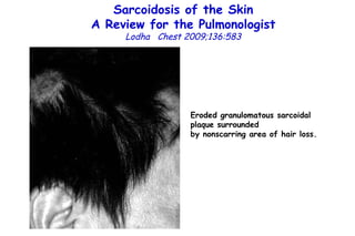 Sarcoidosis of the Skin A Review for the Pulmonologist Lodha  Chest 2009;136:583 Eroded granulomatous sarcoidal plaque surrounded by nonscarring area of hair loss. 