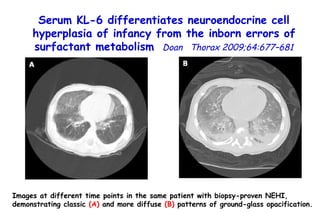 Images at different time points in the same patient with biopsy-proven NEHI, demonstrating classic  (A)  and more diffuse  (B)  patterns of ground-glass opacification.  Serum KL-6 differentiates neuroendocrine cell hyperplasia of infancy from the inborn errors of surfactant metabolism   Doan  Thorax 2009;64:677–681 