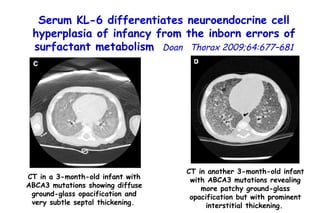 CT in a 3-month-old infant with ABCA3 mutations showing diffuse ground-glass opacification and very subtle septal thickening.   CT in another 3-month-old infant with ABCA3 mutations revealing more patchy ground-glass opacification but with prominent interstitial thickening.   Serum KL-6 differentiates neuroendocrine cell hyperplasia of infancy from the inborn errors of surfactant metabolism   Doan  Thorax 2009;64:677–681 