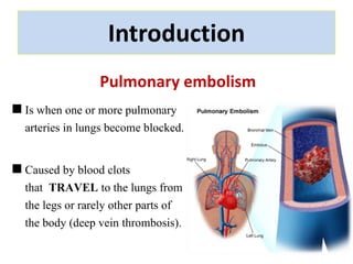 Introduction 
Pulmonary embolism 
Is when one or more pulmonary 
arteries in lungs become blocked. 
Caused by blood clots 
that TRAVEL to the lungs from 
the legs or rarely other parts of 
the body (deep vein thrombosis). 
 