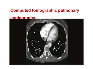 Computed tomographic pulmonary 
angiography. 
 