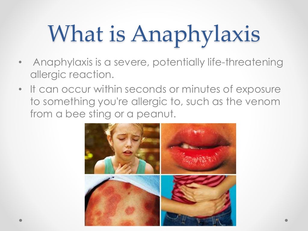 Anaphylaxis anaphylaxis