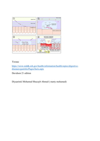 Tixraac
https://www.niddk.nih.gov/health-information/health-topics/digestive-
diseases/gastritis/Pages/facts.aspx
Davidson 21 edition
Diyaarintii Mohamed Shucayb Ahmed ( marty mohamed)
 