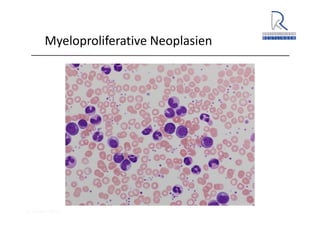 A. Wacker 2014
Myeloproliferative Neoplasien
 