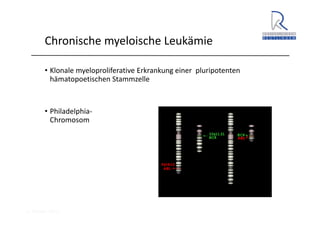 A. Wacker 2014
Chronische myeloische Leukämie
• Klonale myeloproliferative Erkrankung einer  pluripotenten 
hämatopoetischen Stammzelle
• Philadelphia‐
Chromosom
 