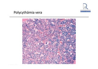 A. Wacker 2014
Polycythämia vera
 