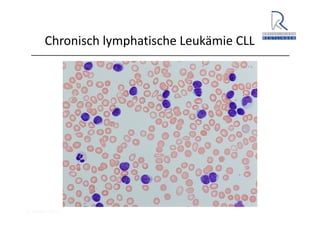 A. Wacker 2014
Chronisch lymphatische Leukämie CLL
 