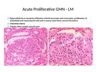 Acute Proliferative GMN - LM
 
