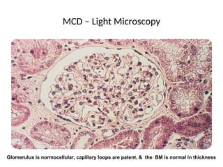 MCD – Light Microscopy
Glomerulus is normocellular, capillary loops are patent, & the BM is normal in thickness
 
