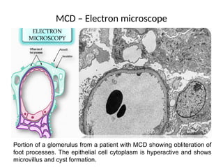 MCD – Electron microscope
Portion of a glomerulus from a patient with MCD showing obliteration of
foot processes. The epithelial cell cytoplasm is hyperactive and shows
microvillus and cyst formation.
 