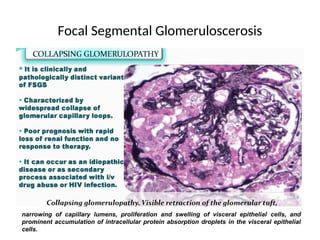 Focal Segmental Glomeruloscerosis
narrowing of capillary lumens, proliferation and swelling of visceral epithelial cells, and
prominent accumulation of intracellular protein absorption droplets in the visceral epithelial
cells.
 