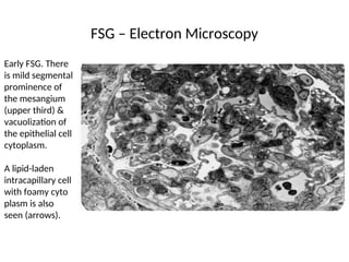 FSG – Electron Microscopy
Early FSG. There
is mild segmental
prominence of
the mesangium
(upper third) &
vacuolization of
the epithelial cell
cytoplasm.
A lipid-laden
intracapillary cell
with foamy cyto
plasm is also
seen (arrows).
 