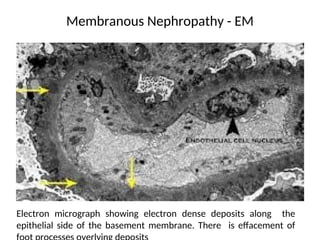 Membranous Nephropathy - EM
Electron micrograph showing electron dense deposits along the
epithelial side of the basement membrane. There is effacement of
 