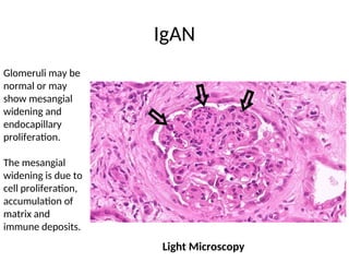 IgAN
Light Microscopy
Glomeruli may be
normal or may
show mesangial
widening and
endocapillary
proliferation.
The mesangial
widening is due to
cell proliferation,
accumulation of
matrix and
immune deposits.
 