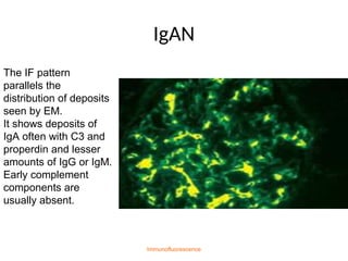 IgAN
Immunofluorescence
The IF pattern
parallels the
distribution of deposits
seen by EM.
It shows deposits of
IgA often with C3 and
properdin and lesser
amounts of IgG or IgM.
Early complement
components are
usually absent.
 