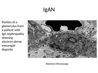 IgAN
Electron Microscopy
Portion of a
glomerulus from
a patient with
IgA nephropathy
showing
electron-dense
mesangial
deposits
 