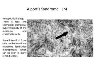 Nonspecific findings.
There is focal and
segmental glomerular
hypercellularity of the
mesangial and
endothelial cells.
Renal interstitial foam
cells can be found and
represent lipid-laden
macrophages which
can be seen in many
renal diseases.
Alport’s Syndrome - LM
 