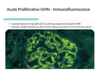 Acute Proliferative GMN - Immunofluorescence
 
