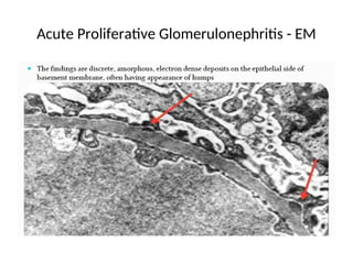 Acute Proliferative Glomerulonephritis - EM
 