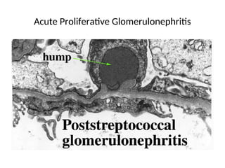 Acute Proliferative Glomerulonephritis
 