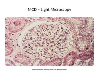 MCD – Light Microscopy
Glomerulus is normocellular, capillary loops are patent, & the BM is normal in thickness
 