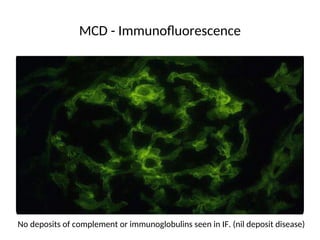 MCD - Immunofluorescence
No deposits of complement or immunoglobulins seen in IF. (nil deposit disease)
 