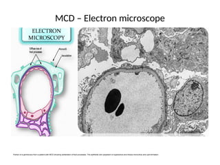 MCD – Electron microscope
Portion of a glomerulus from a patient with MCD showing obliteration of foot processes. The epithelial cell cytoplasm is hyperactive and shows microvillus and cyst formation.
 